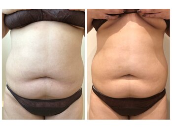 エイシスグロウ(asis glow.)/効果写真