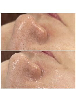 アイリーン(IRENE)/毛穴洗浄の効果実感♪