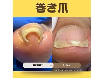 巻き爪補正店 那覇店