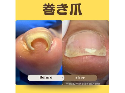 巻き爪補正店 那覇店の写真