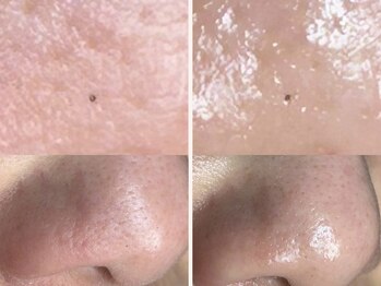 コハク(kohaku)/ララピール ビフォー/アフター