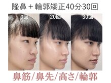 ラプリ 大阪心斎橋店(Raplit)/隆鼻＋輪郭矯正40分30回