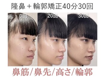ラプリ 大阪心斎橋店(Raplit)/隆鼻＋輪郭矯正40分30回