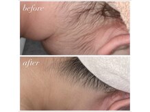 アンドユクス 国分寺(&uks)/うなじ脱毛 ビフォアフ