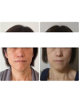 ミモザ 佐野(mimosa)/50代リフトアップ、ほうれい線