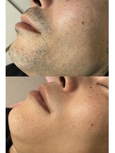 ディサイドロー(DECIDE L.A.W)/全顔脱毛