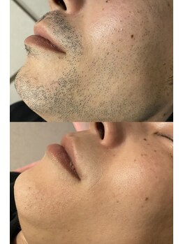 ディサイドロー(DECIDE L.A.W)/全顔脱毛