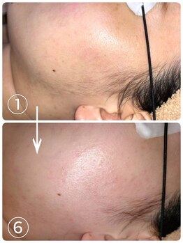 アンドユクス 表参道(and uks)/【症例】レディース/顔脱毛