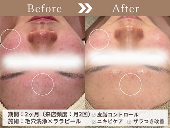 ファッショニスタ 恵比寿東口(Fashionista)/ララピール/ニキビ ざらつき改善