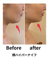 ビービー(BB)/ハイパーナイフ顔