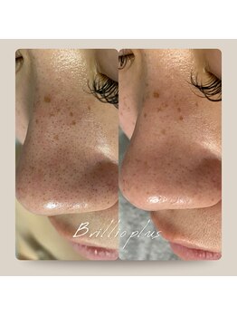 ブリリオプラス 四条烏丸店(Brillio plus)/ハイドラフェイシャル