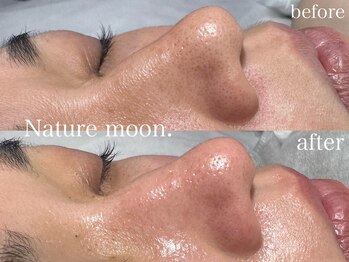 ナチュールムーン(Nature moon.)/毛穴洗浄