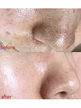 ビューティーガーデン(Beauty Garden)/黒ずみ毛穴をなんとかしたい