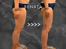 レナータ 大宮店(RENATA)の雰囲気（【脂肪冷却】食事制限なしでここまで変わる！！合計10回施術◎）