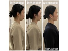 カワル整体 上通り院/姿勢矯正による小顔効果の関係