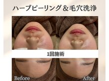 イーラボ 池袋店(e-LABO)/毛穴洗浄×国産ハーブピーリング