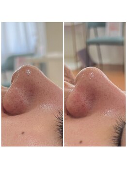 アイリーン(IRENE)/毛穴洗浄の効果実感♪