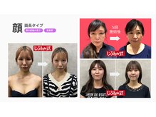 じぶんdeエステ 梅田店/CELLZERO.式症例４