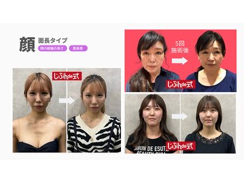 じぶんdeエステ 梅田店/CELLZERO.式症例4
