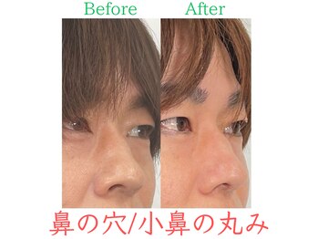 ラプリ 福岡博多店(Raplit)/隆鼻+輪郭・小顔矯正 美鼻/小顔