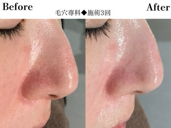 フレイヤ(FREYA)/毛穴専科Before→After