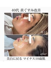 レイ(Rey)/気になるくすみが1度で改善