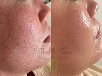プライベートサロン タンタン(tantan)/ごわつき/繰り返すニキビ　30代