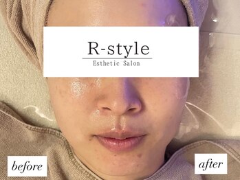 エステサロン アールスタイル(R-style)/半顔施術ビフォーアフター写真