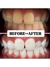 ホワイトニングサロン 豊中/Before&After美白ホワイトニング