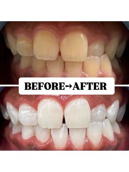 ホワイトニングサロン 豊中/Before&After美白ホワイトニング