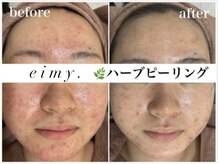 エイミー 名古屋駅前店(eimy.)/ハーブピーリング/名古屋