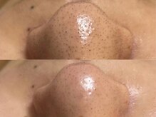 GRACETHOUSAND(グレイスサウザンド)/ハイドラ毛穴洗浄/毛穴吸引/毛穴