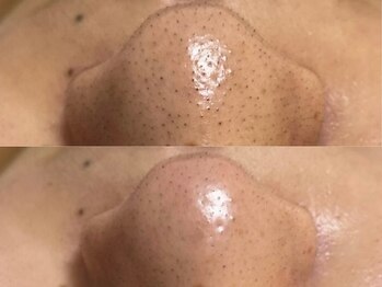 GRACETHOUSAND(グレイスサウザンド)/ハイドラ毛穴洗浄/毛穴吸引/毛穴