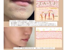 ブレスユー 北堀江(bless you)/オーロラ・ハーブピーリング