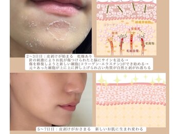 ブレスユー 北堀江(bless you)/オーロラ・ハーブピーリング
