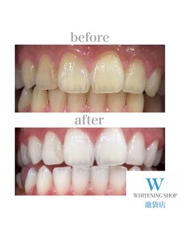 ホワイトニングショップ 池袋店/【ビフォーアフター】美白