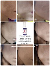 ラ ルミエール(La Lumiere)/シミ改善に向けてコツコツケア