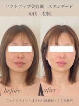 めい鍼灸院/美容鍼灸　ビフォーアフター