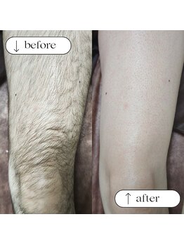 キナリ(kinari)/脚ワックス脱毛