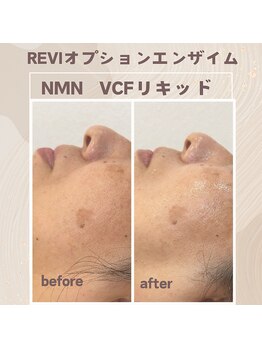 シエロ(Cielo)/REVI陶肌トリートメントシミケア