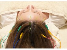 アモ(amo)/頭皮鍼