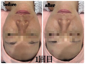 シルク(Cilk)/毛穴洗浄＋ハーブピーリング