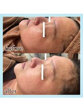 レヴール(reveur)/ビフォーアフター[フェイシャル]