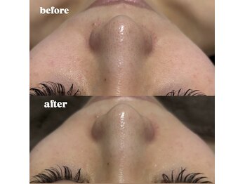 ウィズティ(with.T)/毛穴洗浄+ジェリーマスク