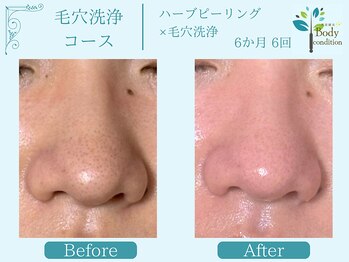 ボディコンディション/ハーブピーリング/毛穴洗浄/小顔