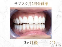 ホワイヤ セルフホワイトニング DBS神楽坂(Whi-Ya)/☆サブスク会員様☆納得の白さ☆