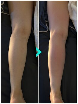 ミルキー(Milky)/膝のお痛み我慢していませんか？