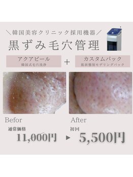 HEYON【毛穴/肌質改善専門サロン】心斎橋の写真/まずはお試し☆【毛穴詰まり/ざらつき改善◇韓国式毛穴洗浄+お肌悩み別カスタムパック30分初回¥5500】