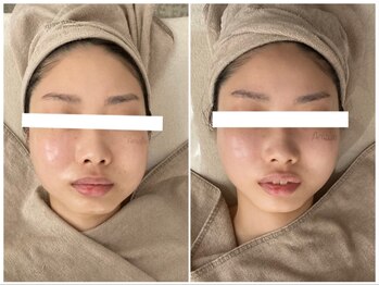 アマリエ/食いしばり・エラ張り改善コース