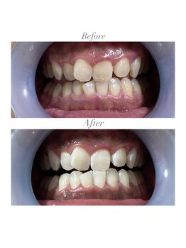 ホワイトニングショップ 静岡店/ホワイトニングBefore→After